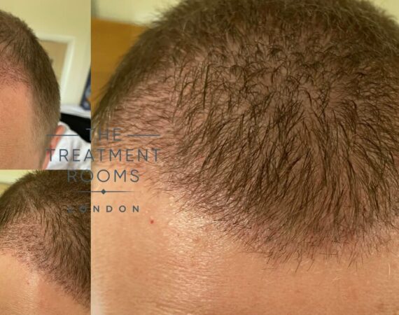 Achieve Your Aesthetic Goals with the Best Hair Transplant in Jaipur