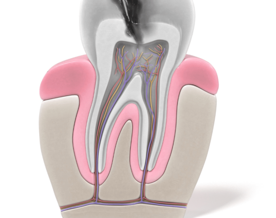 Root Canal Treatment in Islamabad: Restoring Your Smile and Oral Health
