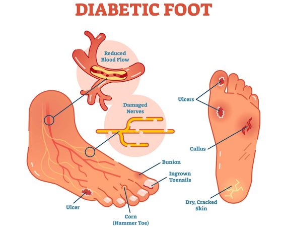 Diabetic Foot Ulcers Drug Pipeline Analysis