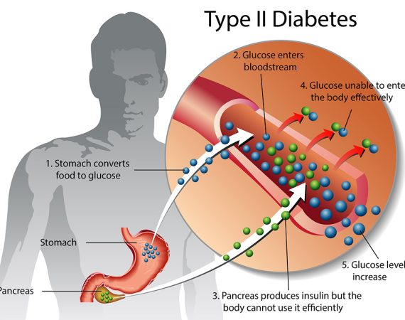 Type 2 Diabetes Drug Pipeline Analysis Report 2024