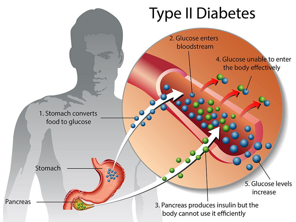 Type 2 Diabetes Drug Pipeline Analysis Report 2024