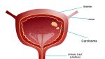 Urothelial Carcinoma