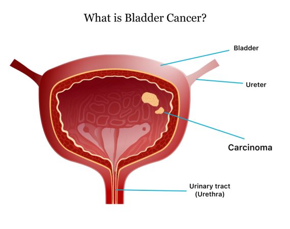 Urothelial Carcinoma