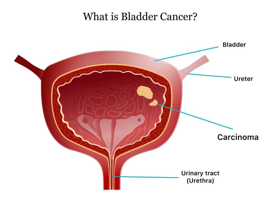 Urothelial Carcinoma