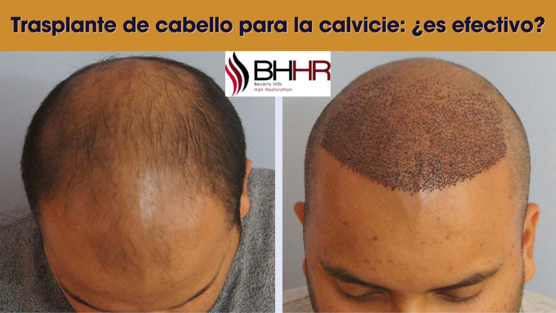 transplante de cabello